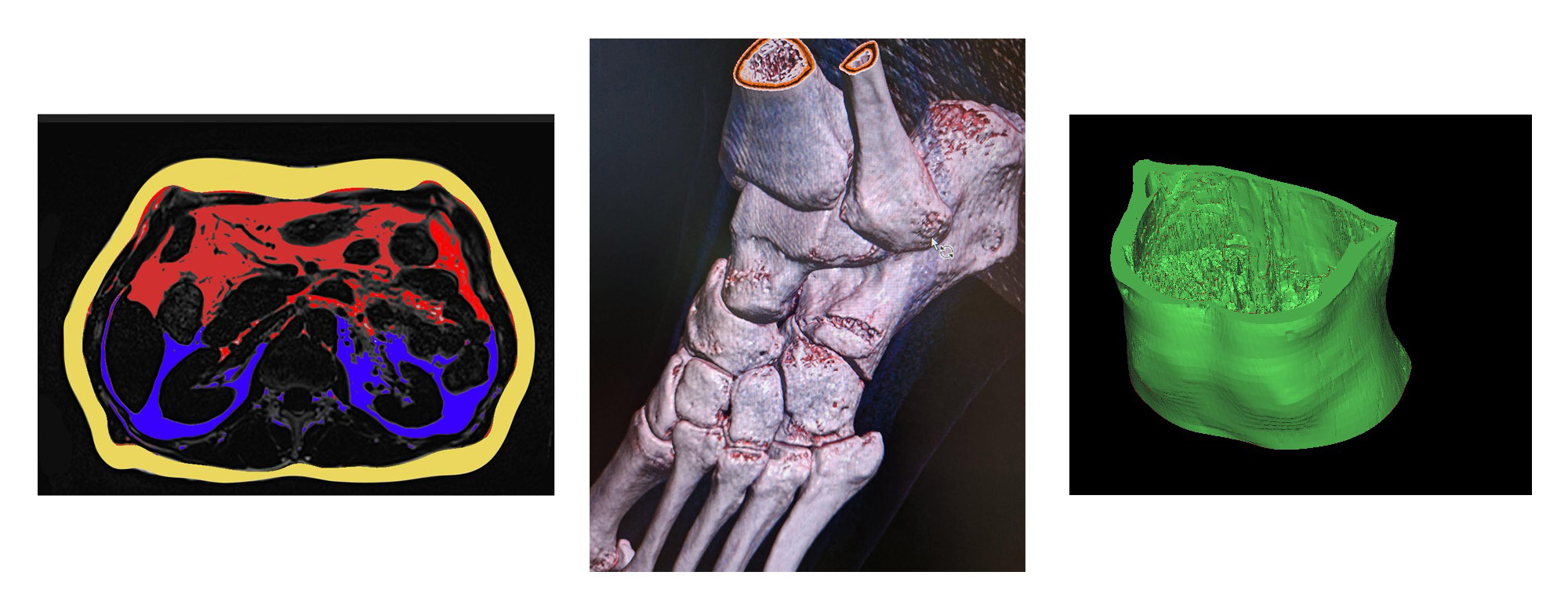 A side-view MRI showing the precise distribution of fat around vital organs; 3D view of foot bones, a 3D MRI of abdominal fat, used to predict risks like diabetes and heart disease years before symptoms appear.