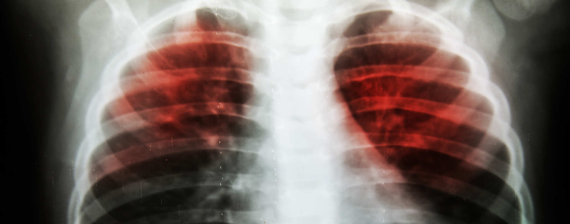 Lungs affected by Tuberculosis