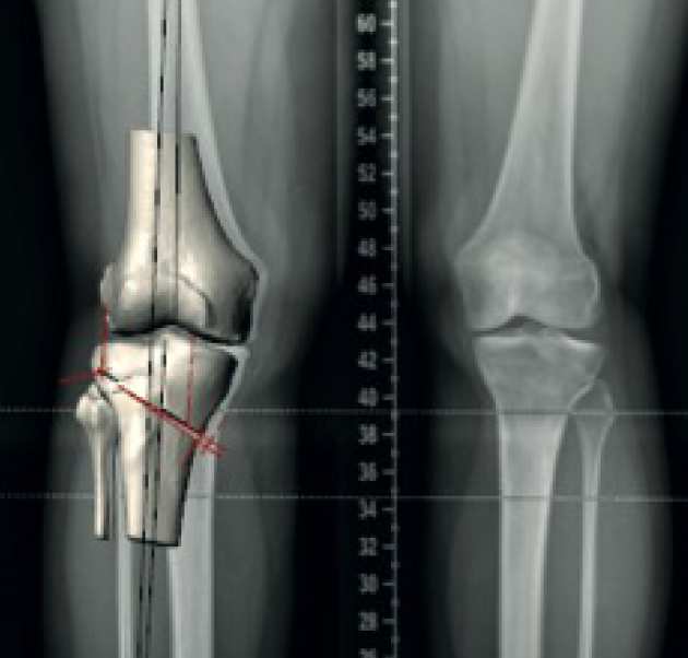 Knee deformity