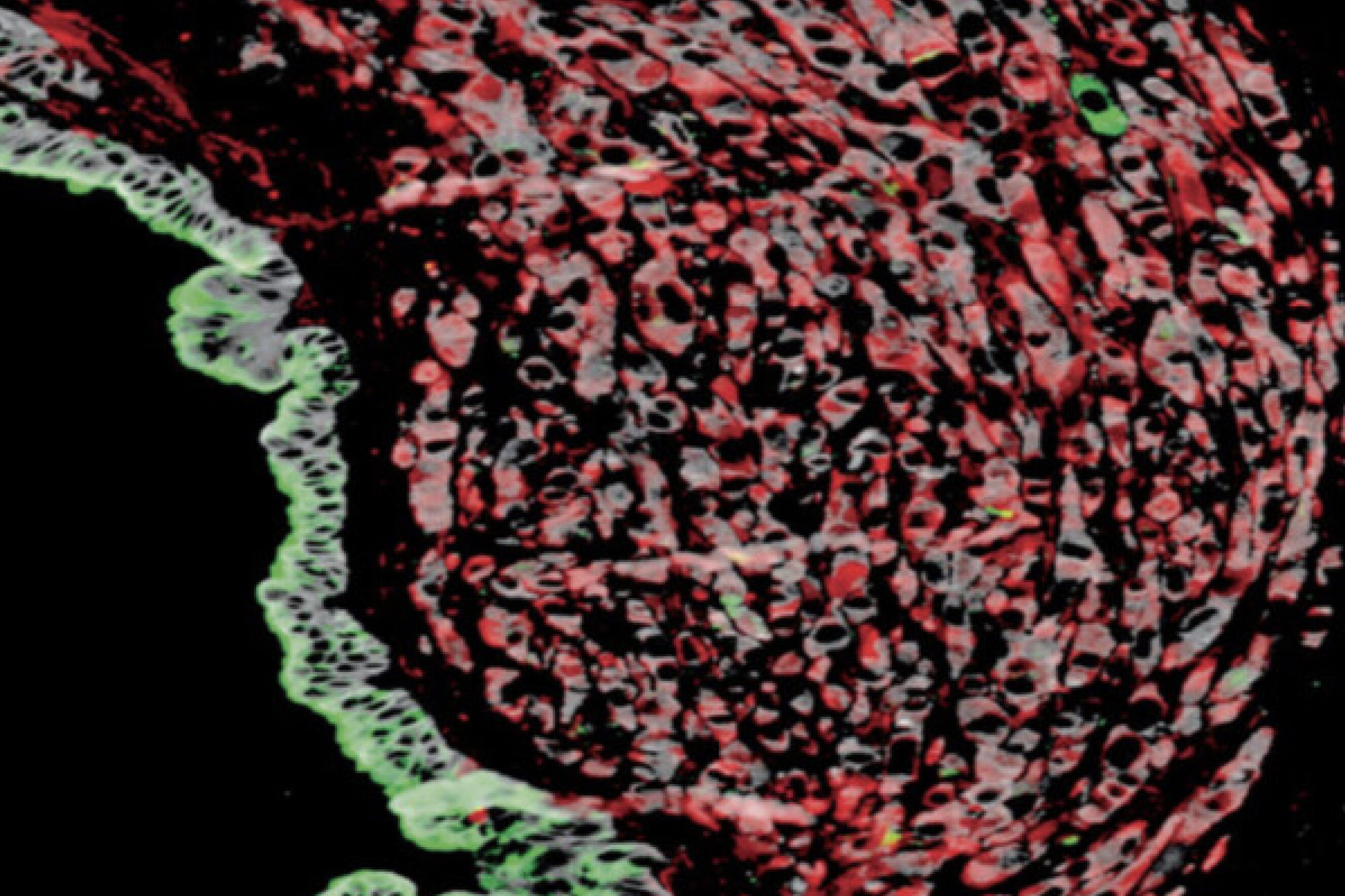 an image of Pancreatic Cancer